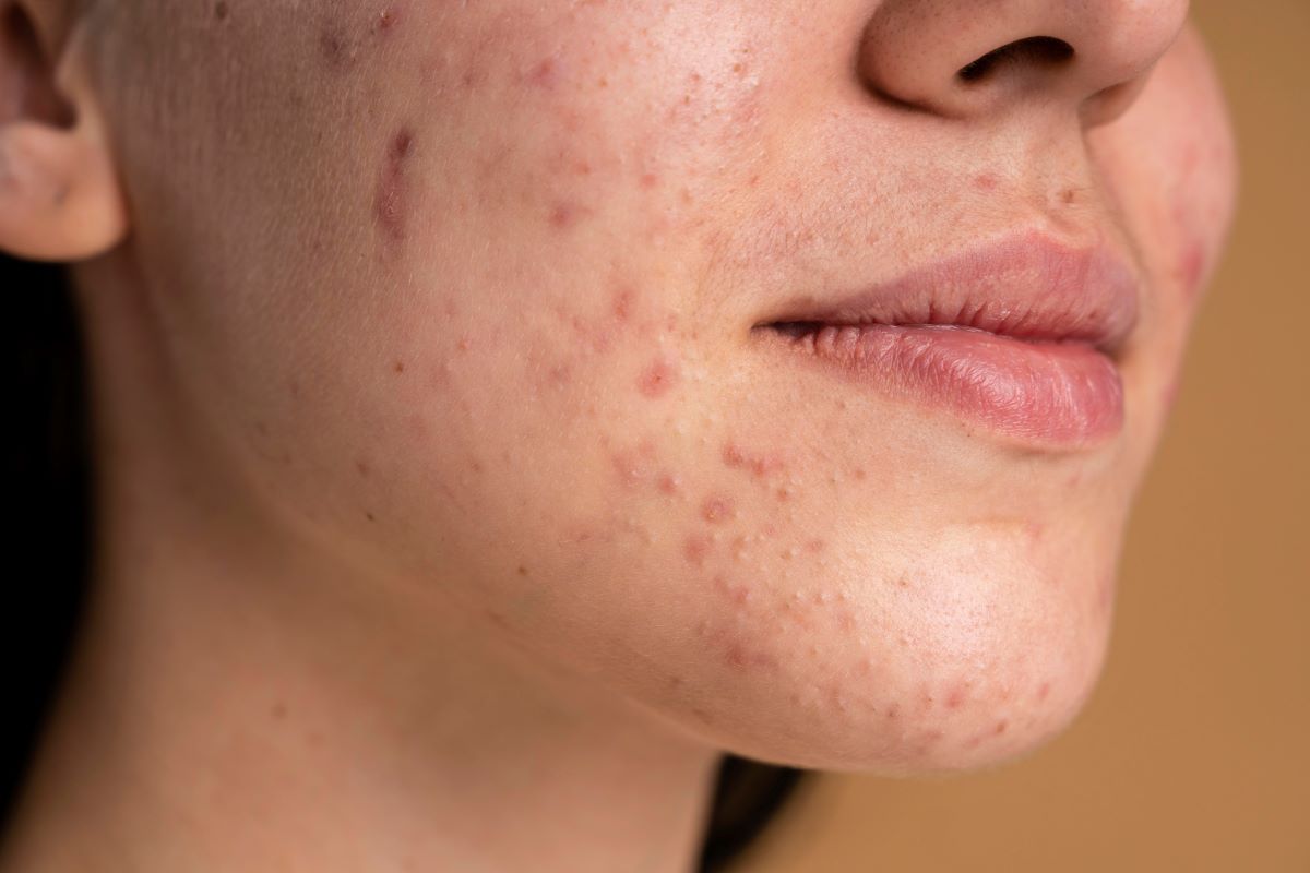 Hormonal Acne - How It Affects Women, Its Causes, and Solutions to This Problem